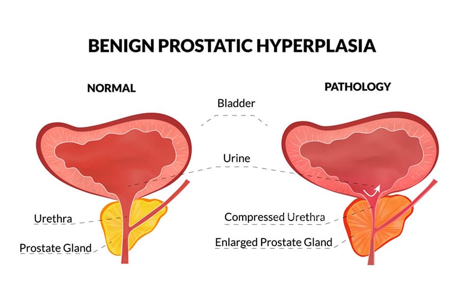 Benign Prostate Hyperplasia Best Treatment Urology Of Virginia