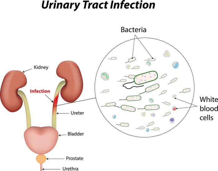 Recurrent UTI Painful Condition Urological Care Services